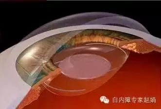为父母必须了解的眼科知识:白内障手术后又看不见了,是怎么回事?