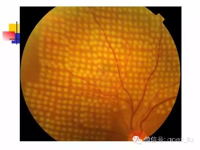 > 眼底造影和激光(3)