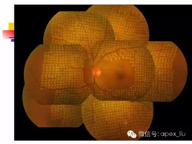 > 眼底造影和激光(3)