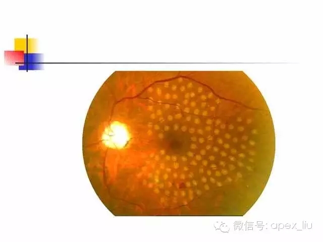 > 眼底造影和激光(3)