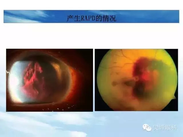 瞳孔检查知多少?——