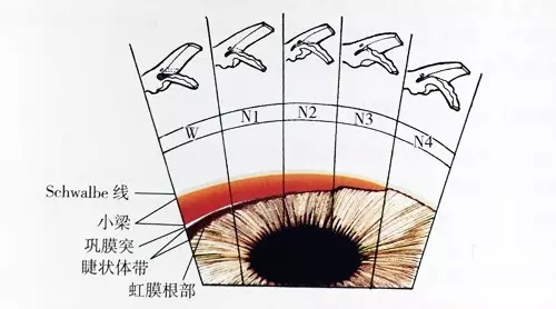 所以,散瞳是否导致青光眼急性发作的主要影响因素应该是"房角".