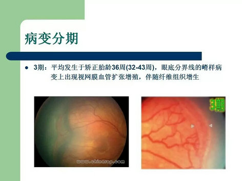 早产儿视网膜病变的表现及治疗原则_眼科网_.
