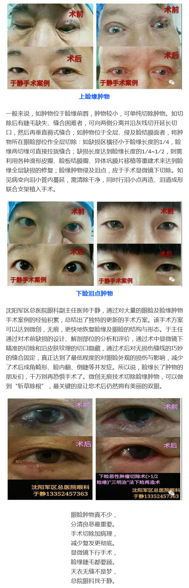 微创无痕技术治疗睑缘肿物(附10例效果图)_中国眼科网