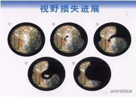 > 世界青光眼周丨青光眼
