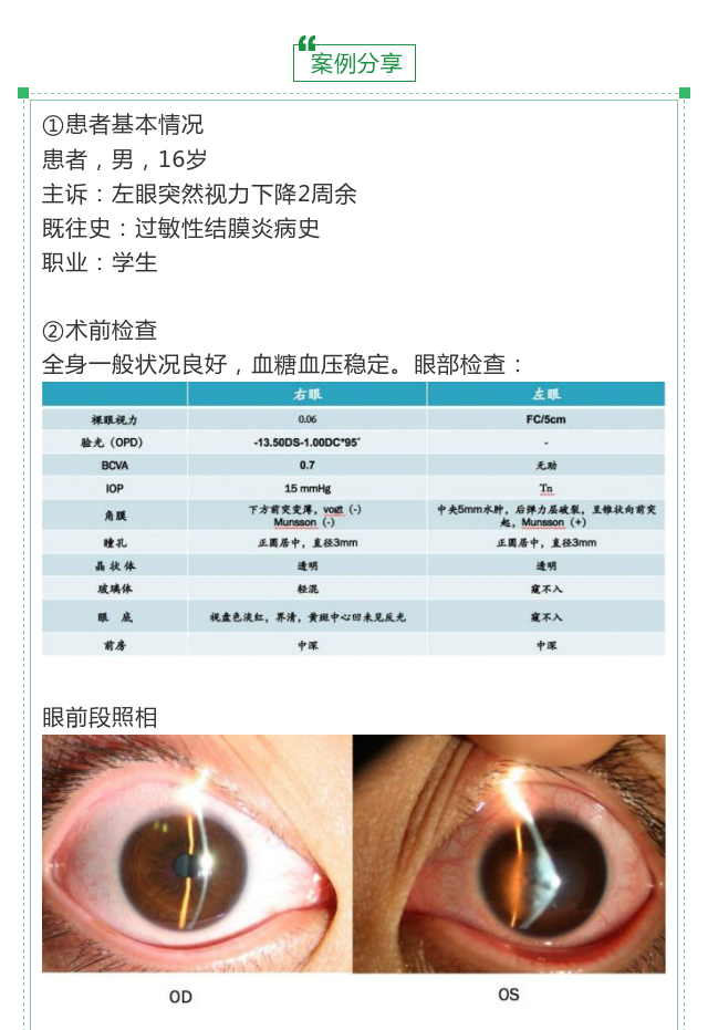 【郭海科 眼科继教】圆锥角膜——之急性角膜水肿_网