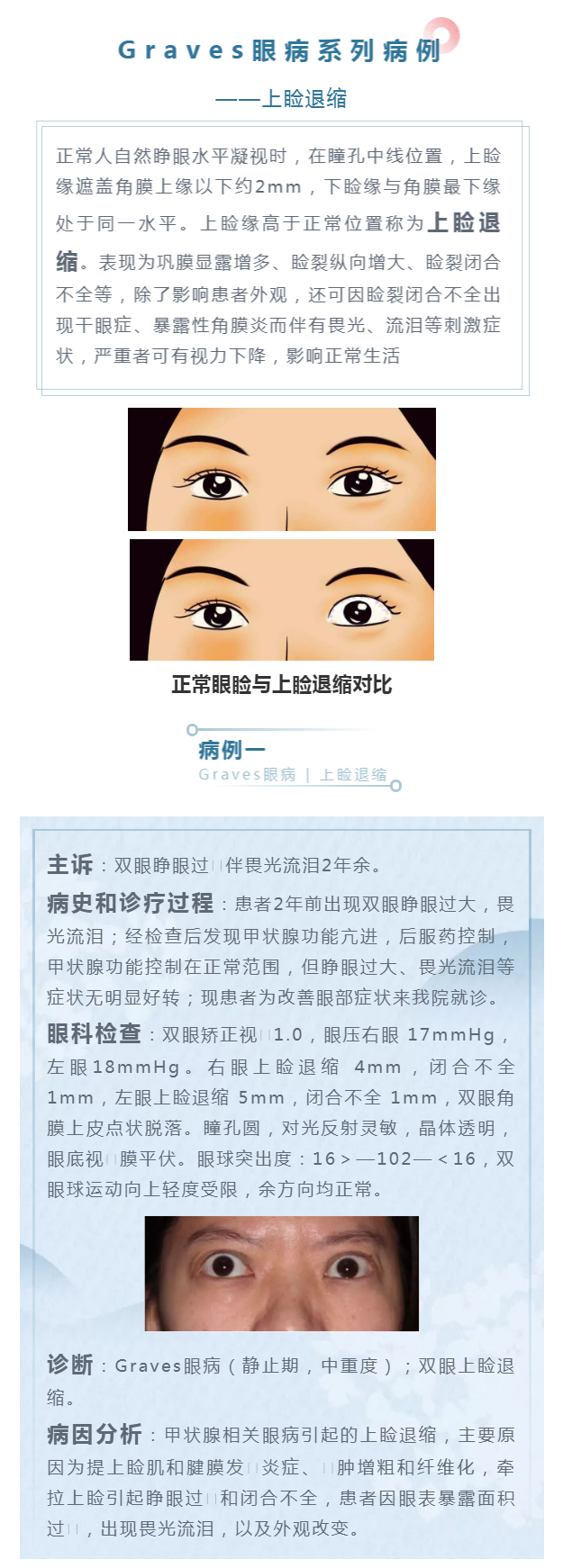 graves眼病系列九