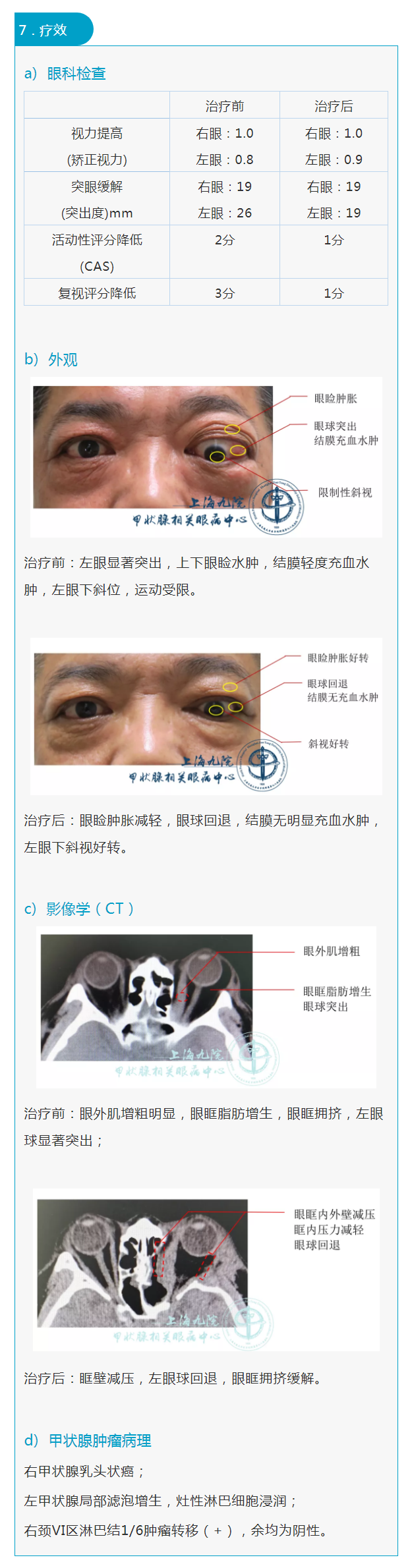 graves眼病系列九