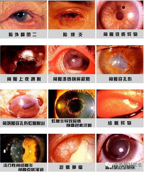 眼病种类图片