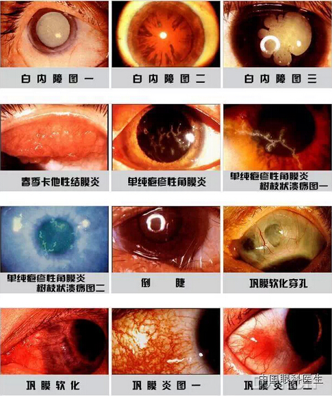 眼部疾病有哪些种类图片