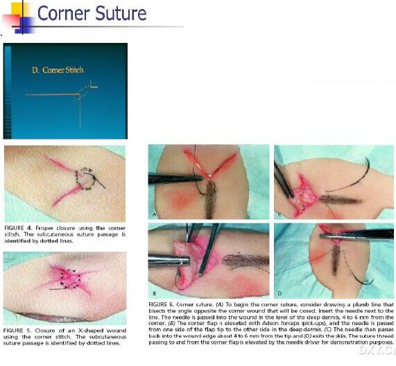 > 整形美容切口缝合技巧