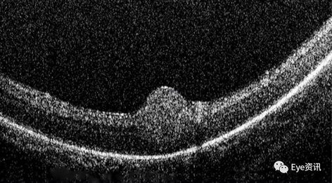 视网膜母细胞瘤超声图片