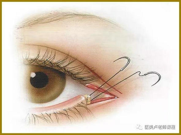 外眦的解剖结构与外眦开大术_中国眼科网_www.yanke360.com