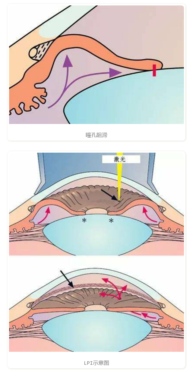 激光周边虹膜切除术图片