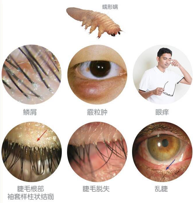 神奇！用筷子滚一滚、揉一揉，就可以将眼睛里的虫子赶出来？——没那么简单！