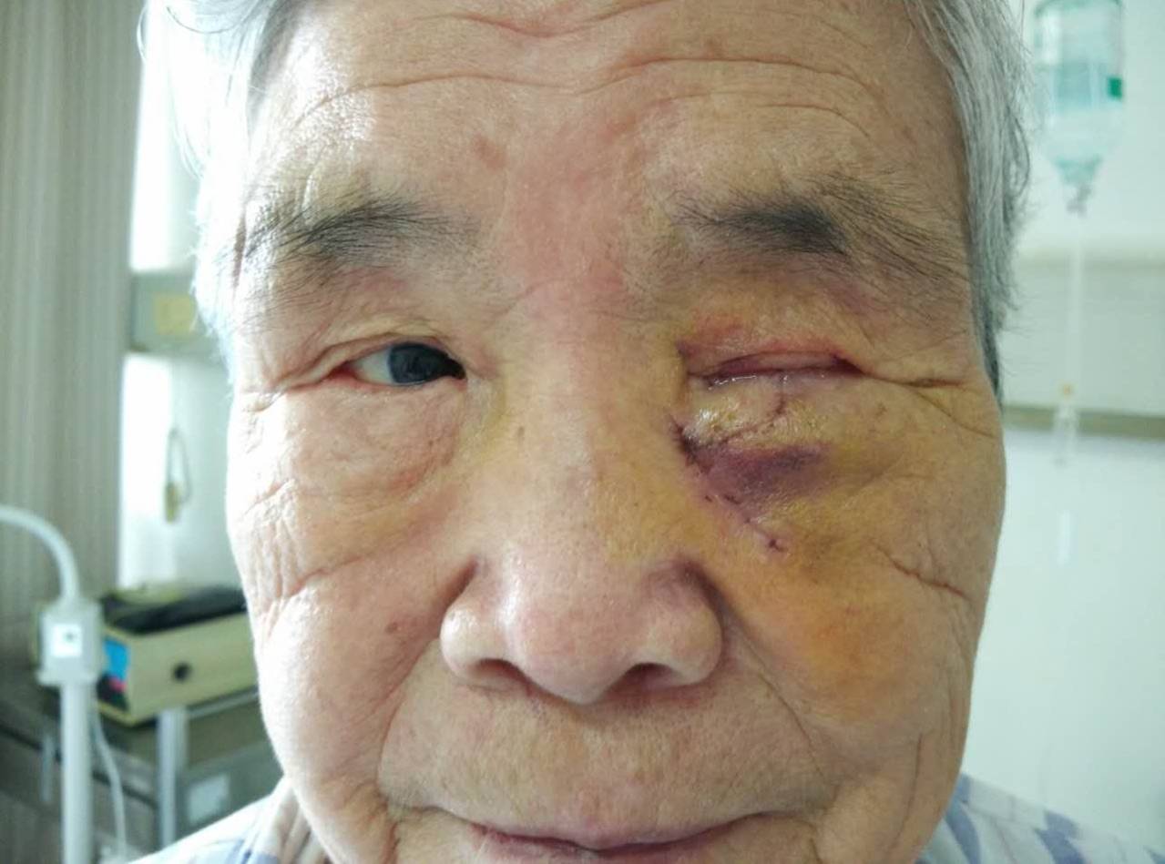 下睑基底细胞癌手术1