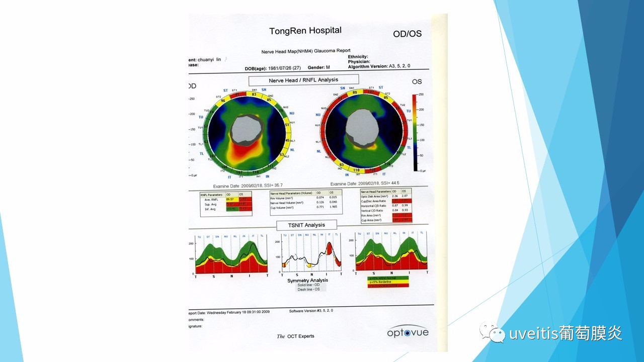青光眼视野检查报告单