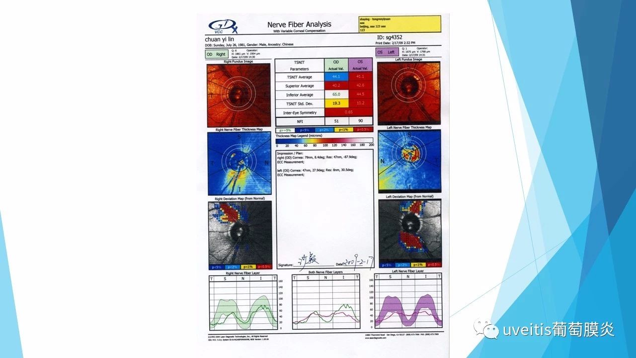 青光眼视野检查报告单