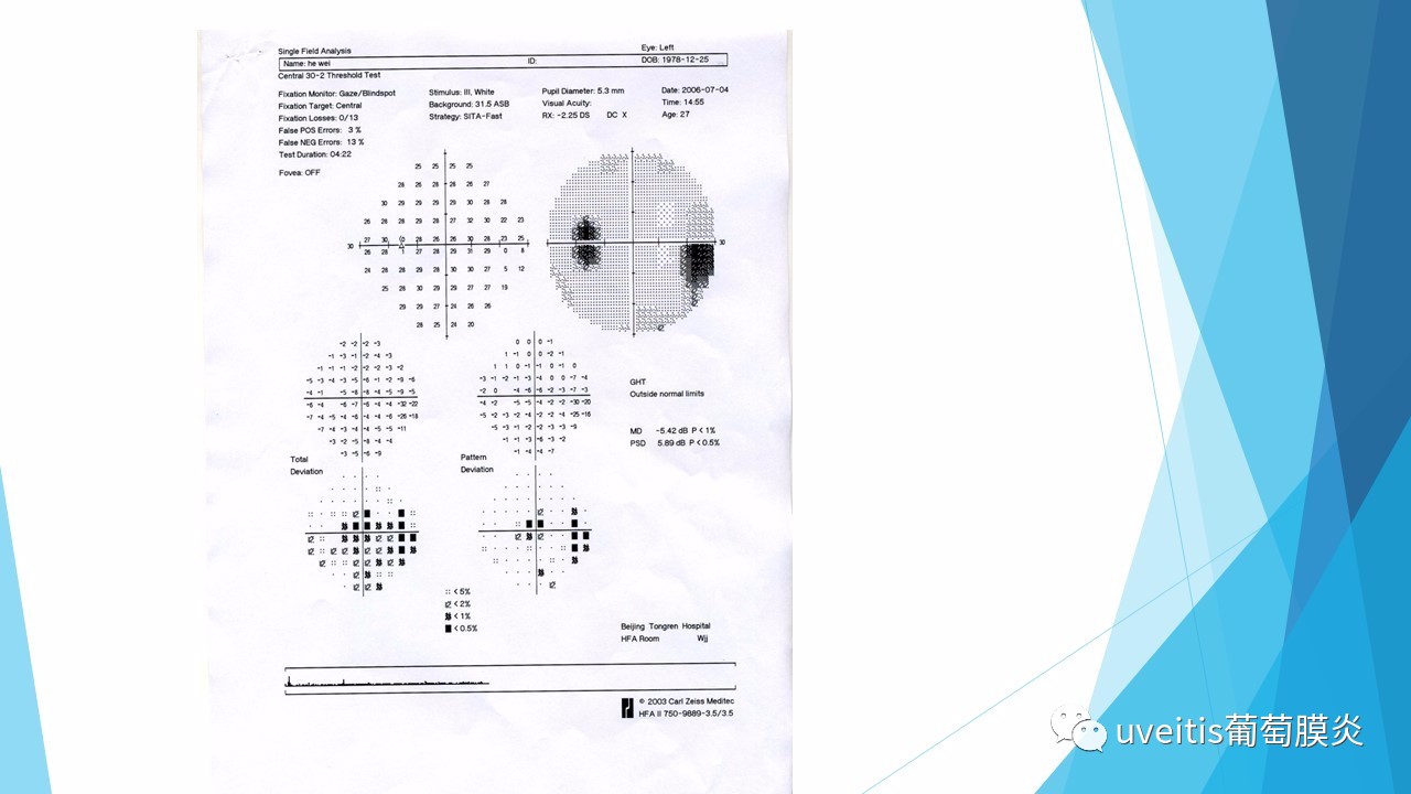 青光眼视野检查报告单