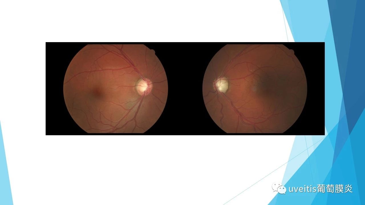 青光眼视野检查报告单