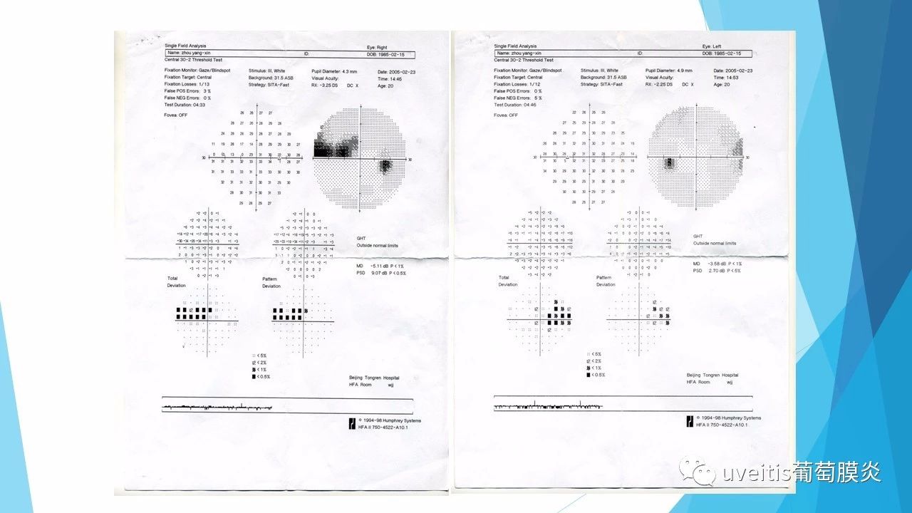 青光眼视野检查报告单