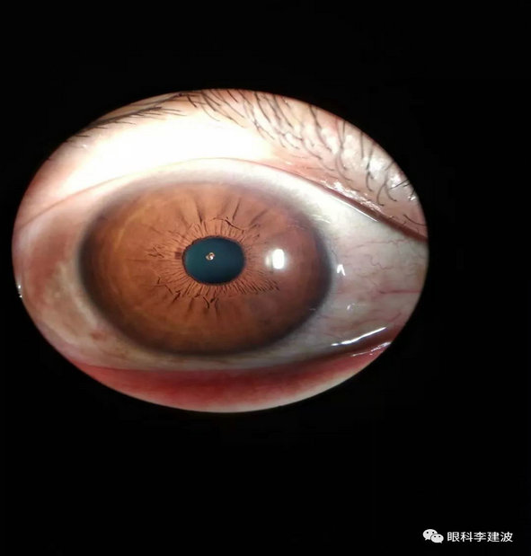 波波裂隙灯下摄影作品