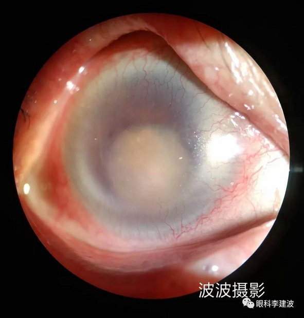 瞳孔闭锁白化病患者虹膜颜色改变玻璃体变性视网膜脱离90d前置镜下