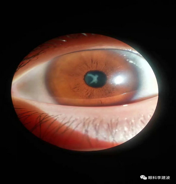 波波裂隙灯下摄影作品