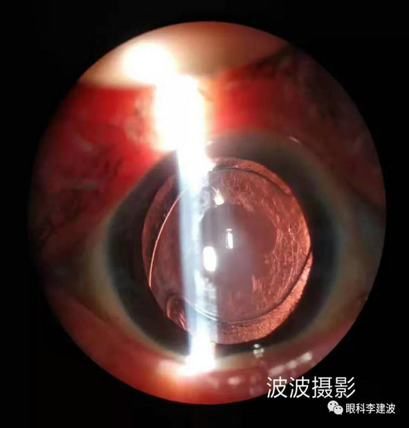 波波裂隙灯下摄影作品