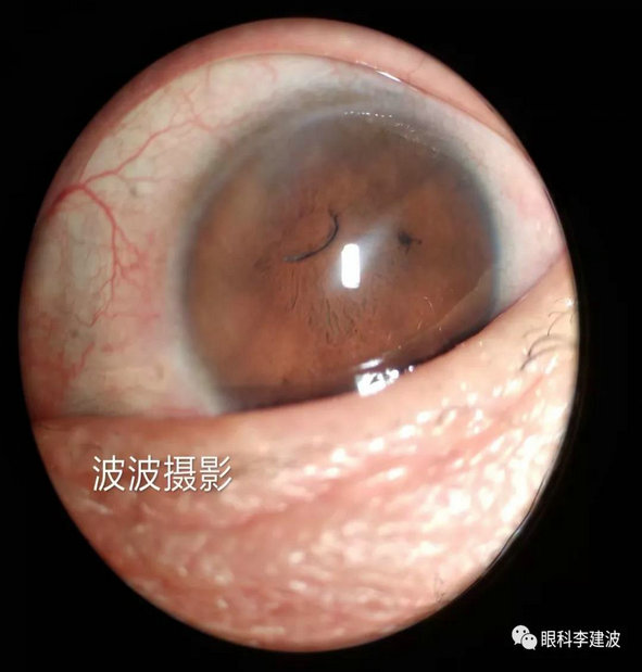 白化病患者虹膜颜色改变玻璃体变性视网膜脱离90d前置镜下所见视乳头
