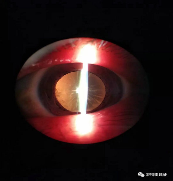 波波裂隙灯下摄影作品