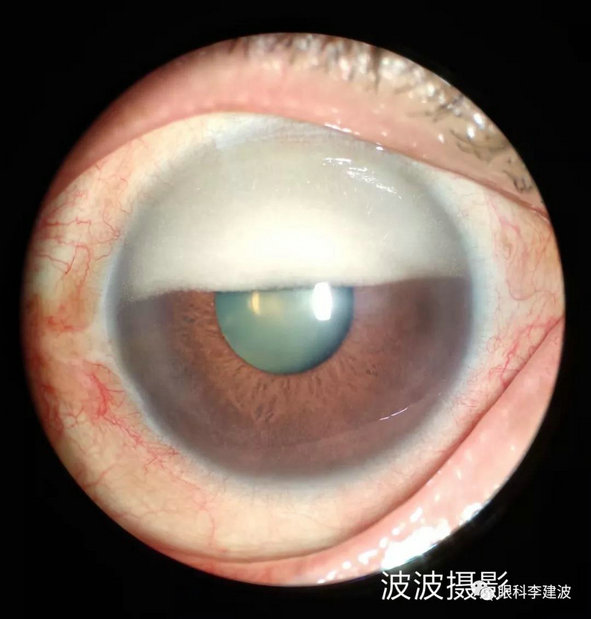 角膜移植术后新生血管性青光眼外伤性前房积血眼外伤虹膜根部离断先天
