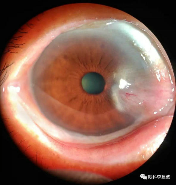 波波裂隙灯下摄影作品