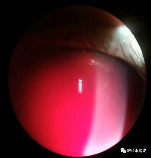 眼外伤虹膜根部离断先天性虹膜残膜虹膜后粘连先天性瞳孔闭锁白化病