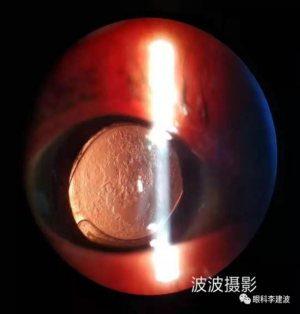 波波裂隙灯下摄影作品