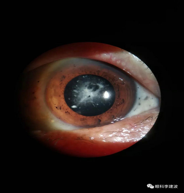 波波裂隙灯下摄影作品