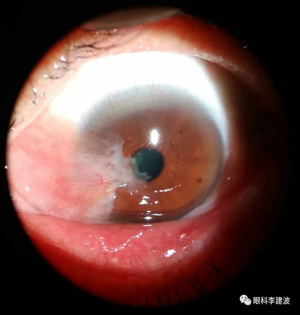 波波裂隙灯下摄影作品