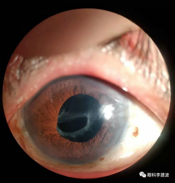 图示)形形色色的白内障角膜上皮损伤睑结膜息肉角膜塑形镜配适(角膜
