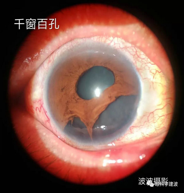 先天性虹膜残膜虹膜后粘连先天性瞳孔闭锁白化病患者虹膜颜色改变玻璃