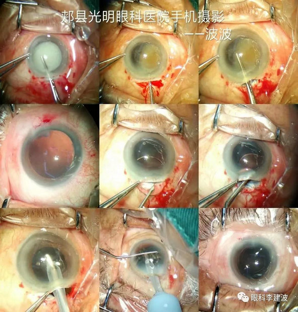波波裂隙灯下摄影作品