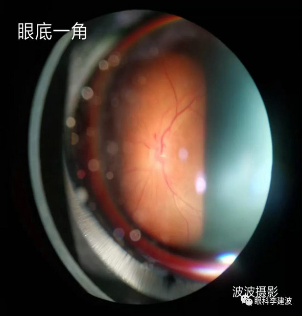 波波裂隙灯下摄影作品
