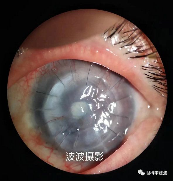 瞳孔闭锁白化病患者虹膜颜色改变玻璃体变性视网膜脱离90d前置镜下