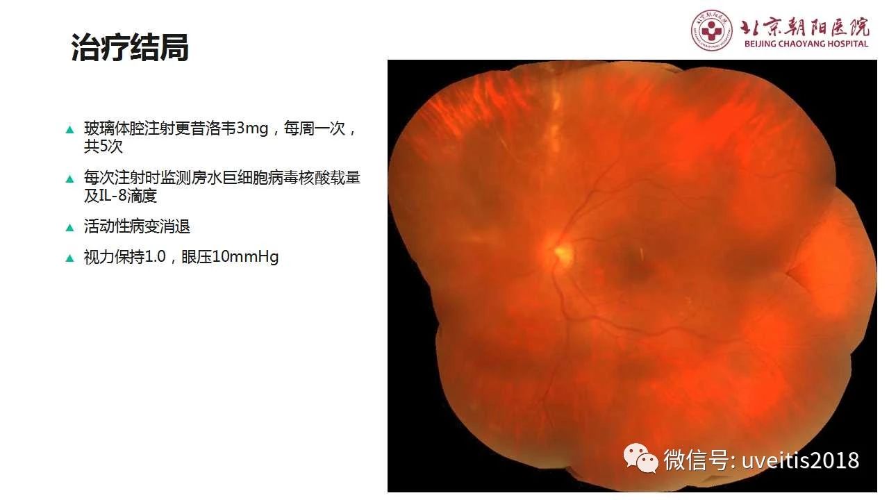 > 巨细胞病毒性视网膜炎