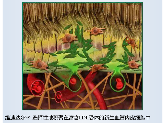 什么是光动力治疗它