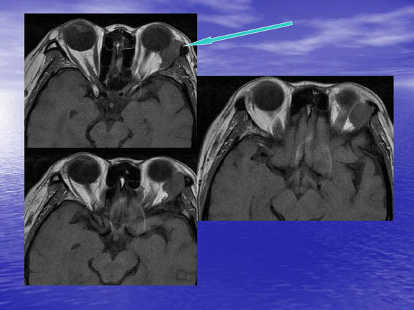 眼眶及眼球病变mr表现