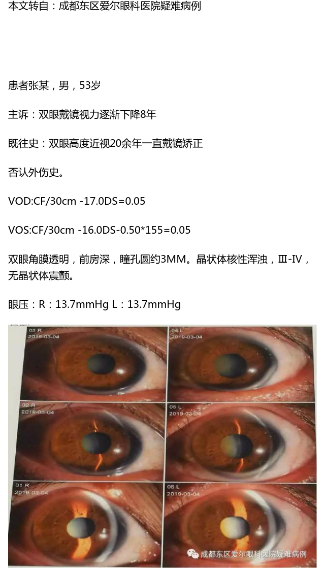 眼底镜下白内障图片图片