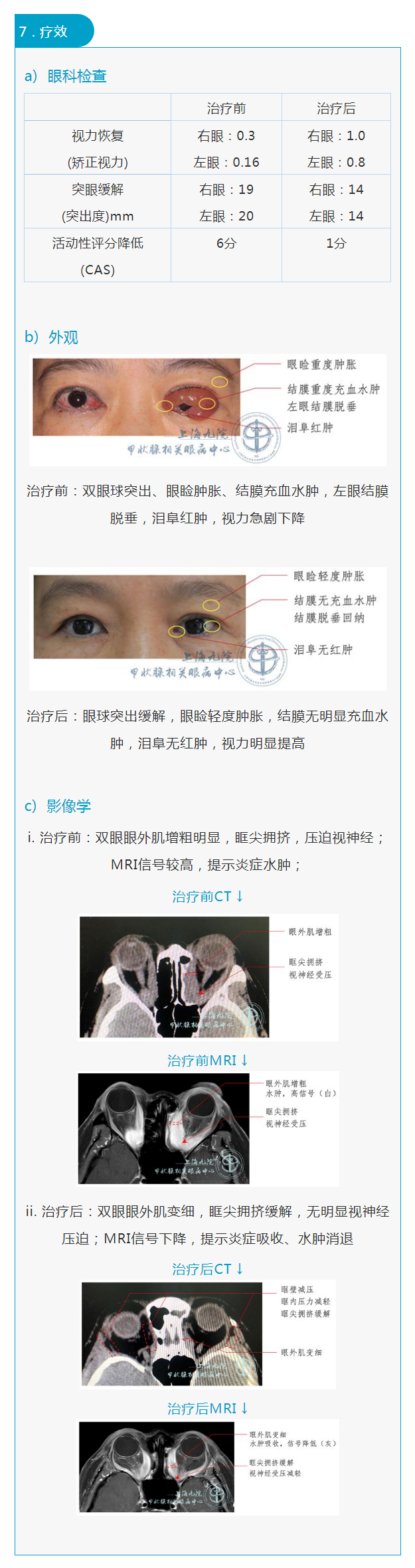 graves眼病系列九